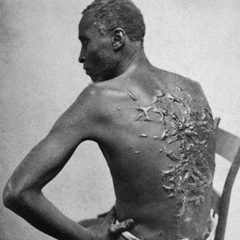 Katowani za życia niewolnicy (na zdj. czarnoskóry mężczyzna z bliznami po batach, fotografia wykonana w Luizjanie w 1863 roku) nawet po śmierci nie zaznali spokoju. Profesorowie Penn wykorzystywali ich ciała jako "pomoce dydaktyczne".